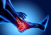 The Feet May Be the First Area to Be Affected by RA
