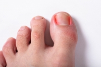 Causes and Treatment for Ingrown Toenails